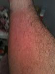Click image for larger version.&nbsp;

Name:	tig burn 001.jpg&nbsp;
Views:	104&nbsp;
Size:	149.3 KB&nbsp;
ID:	4926
